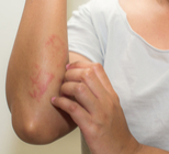 פסוריאזיס ואטופיק דרמטיטיס: תגלית חשובה-תמונה